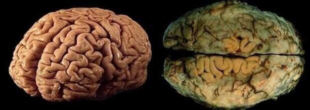 мозъкът на здрав и пиещ човек